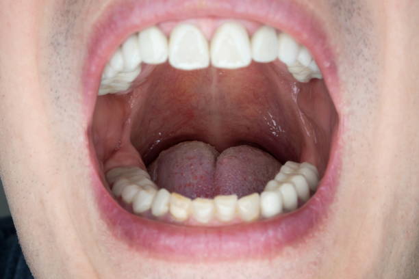 Oral_Thrush