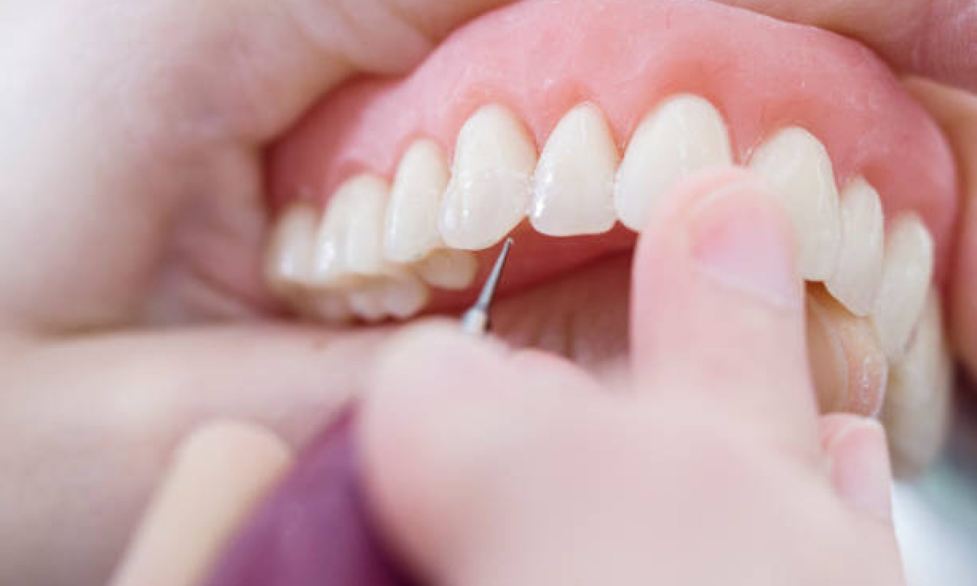 Comparing Different Types of Dental Prosthetics