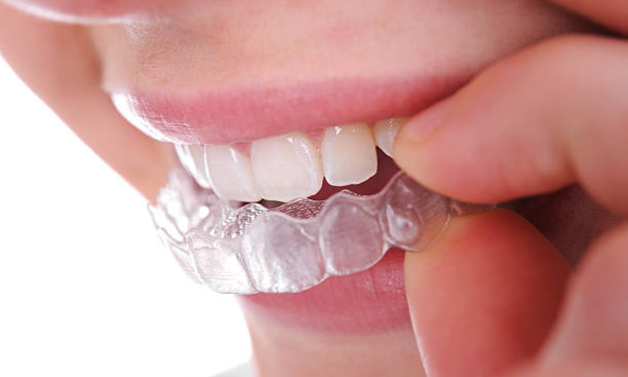 The Advantages of Invisalign for Busy Adults