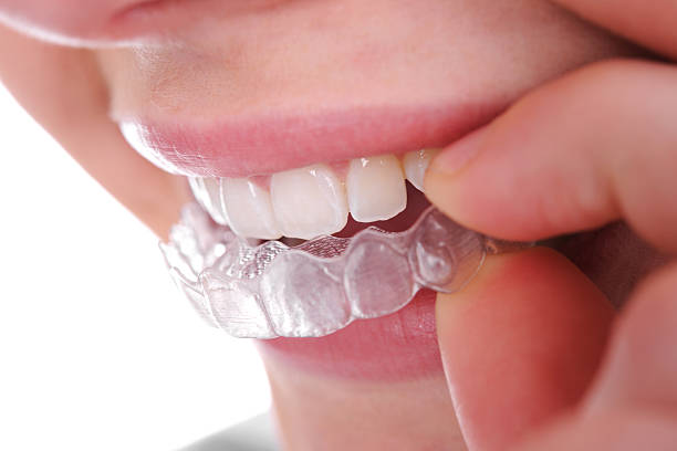 The Advantages of Invisalign for Busy Adults